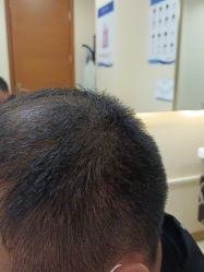 -碧莲盛·不剃发植发