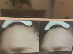 体验后-苑苑vbeauty科技美容SPA