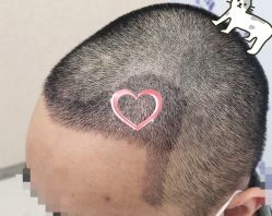 -大麦微针植发全国连锁