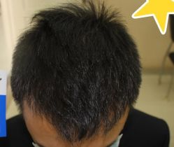 -大麦微针植发丨全国连锁