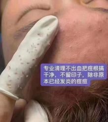 -瑶芳清颜草本祛痘