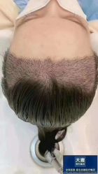 -大麦微针植发丨全国连锁