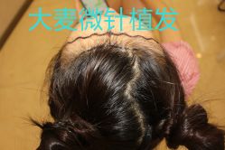 -大麦微针植发丨全国连锁