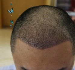 -大麦微针植发丨全国连锁