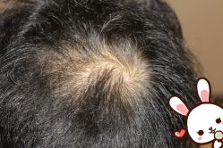 -大麦微针植发丨全国连锁