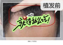 -大麦微针植发全国连锁