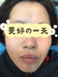 体验前-More摩尔医美の注射线雕光电中心