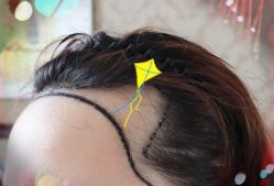 -大麦微针植发全国连锁