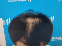 -雍禾植发