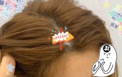 -大麦微针植发全国连锁