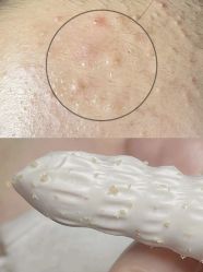 -苗方清颜专业祛痘连锁机构