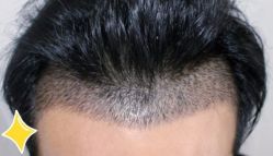 -大麦微针植发丨全国连锁