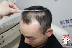 -大麦微针植发丨全国连锁
