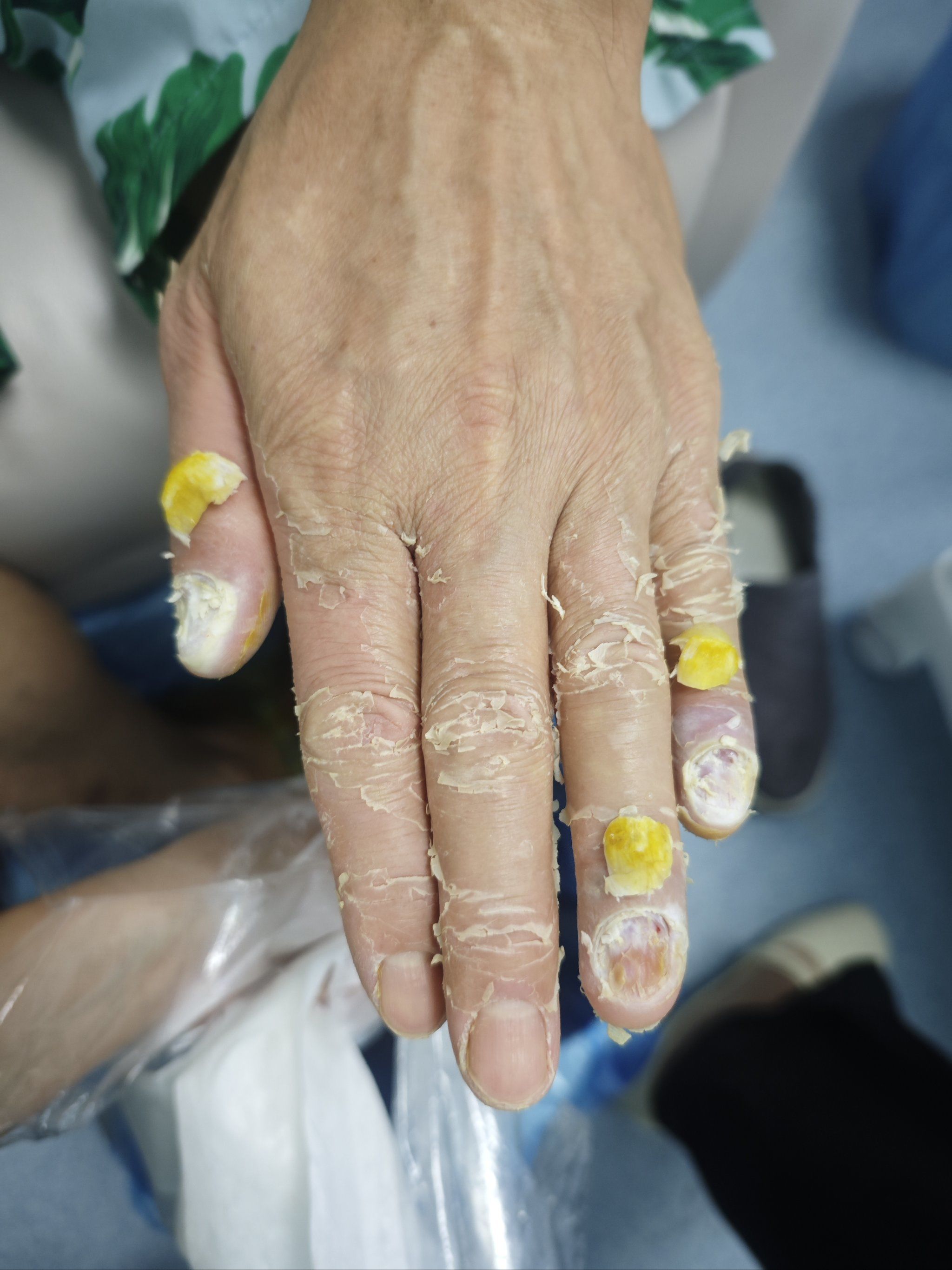 灰指甲祛掉了,指甲会长的好吗?