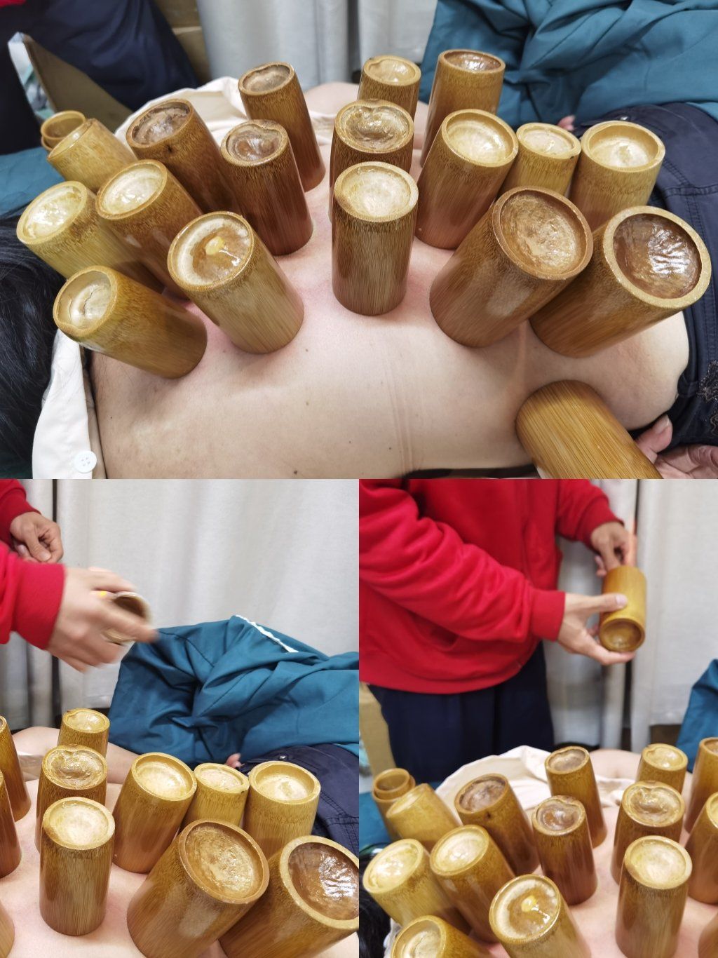 拔罐疗法,中医也能时尚!