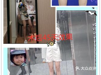 吸脂瘦腿第45天，满屏皆是大长️️