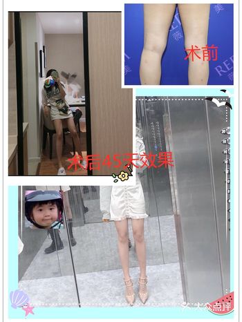 吸脂瘦腿第45天，满屏皆是大长️️