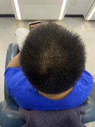 -大麦微针植发全国连锁