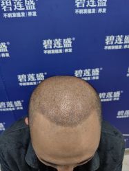 -碧莲盛·不剃发植发