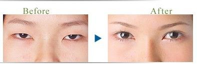 官网-前后对比照-上海华安整形外科门诊部