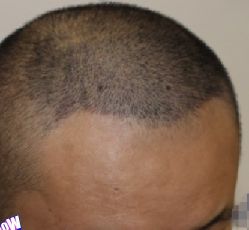 -大麦微针植发丨全国连锁