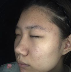 -靓芙泉·0感专研祛痘