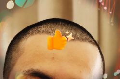 -大麦微针植发全国连锁