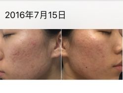 -皇族养心堂·净痘·修敏·御颜