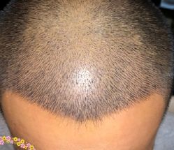 -大麦微针植发丨全国连锁