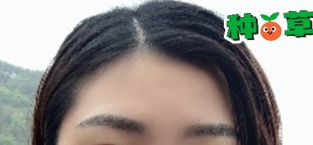 -大麦微针植发丨全国连锁