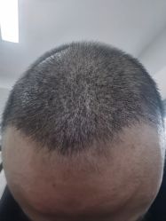体验后-大麦微针植发丨全国连锁
