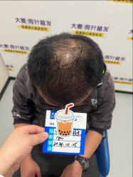 -大麦微针植发全国连锁