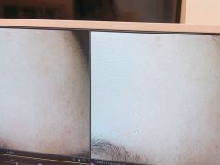 体验后-苑苑vbeauty科技美容SPA