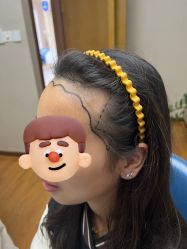 体验前-大麦微针植发全国连锁