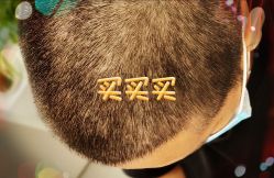 -大麦微针植发全国连锁