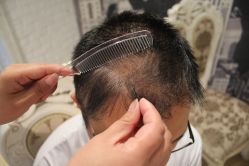 -大麦微针植发丨全国连锁