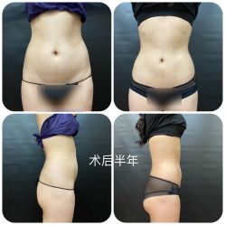 点击看大图 体验后-洁铭新加坡医美