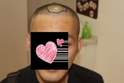 -大麦微针植发丨全国连锁