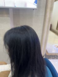 -碧莲盛·不剃发植发