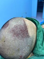 -大麦微针植发全国连锁