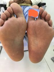 -派恩宜灰指甲鸡眼嵌甲手足癣