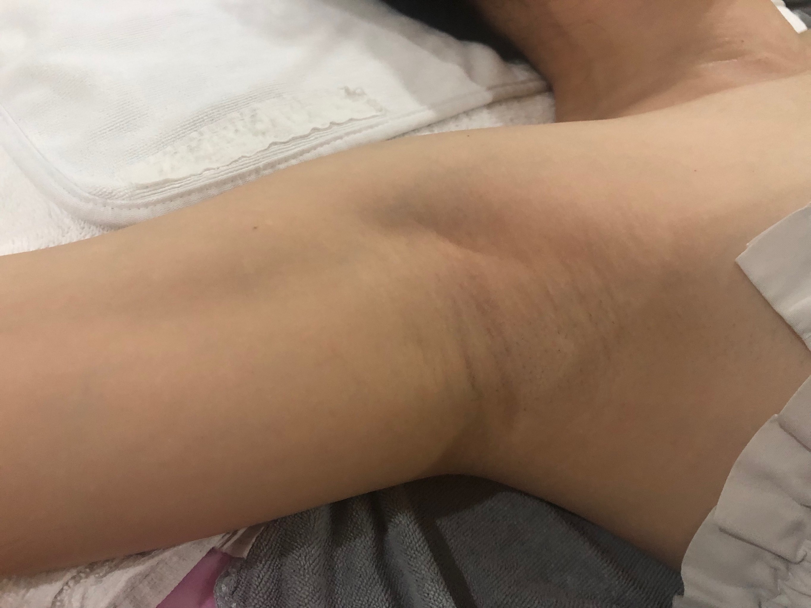 女性腋下淋巴堵塞图片图片