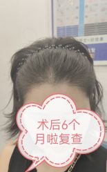 -大麦微针植发全国连锁