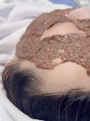 -中科新肌能祛痘祛斑