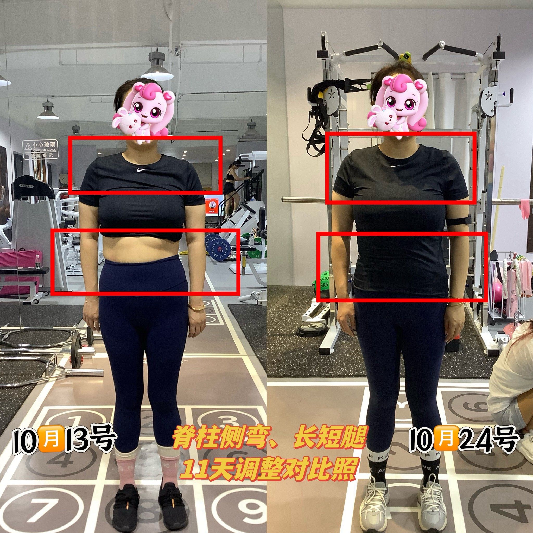 11天对比:脊柱侧弯,高低肩,高低骨盆长短腿