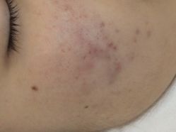 -蕾特恩专业祛痘·皮肤管理