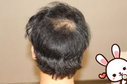 -大麦微针植发丨全国连锁