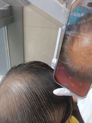 -碧莲盛·不剃发植发