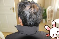 -大麦微针植发丨全国连锁