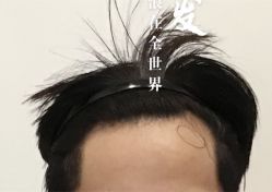 -大麦微针植发全国连锁